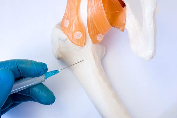 bonemarrowinjection